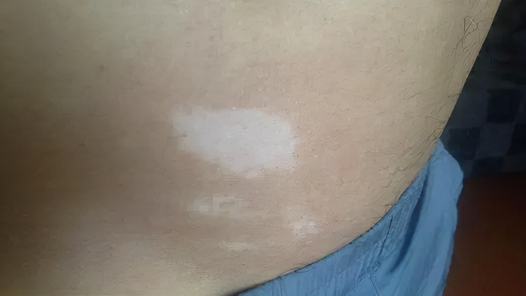 白癜风的常见治疗误区都有哪些,得了白癜风一定要注意这2点