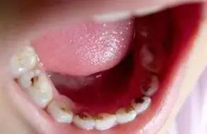 一口黄牙影响颜值,一口黄牙齿