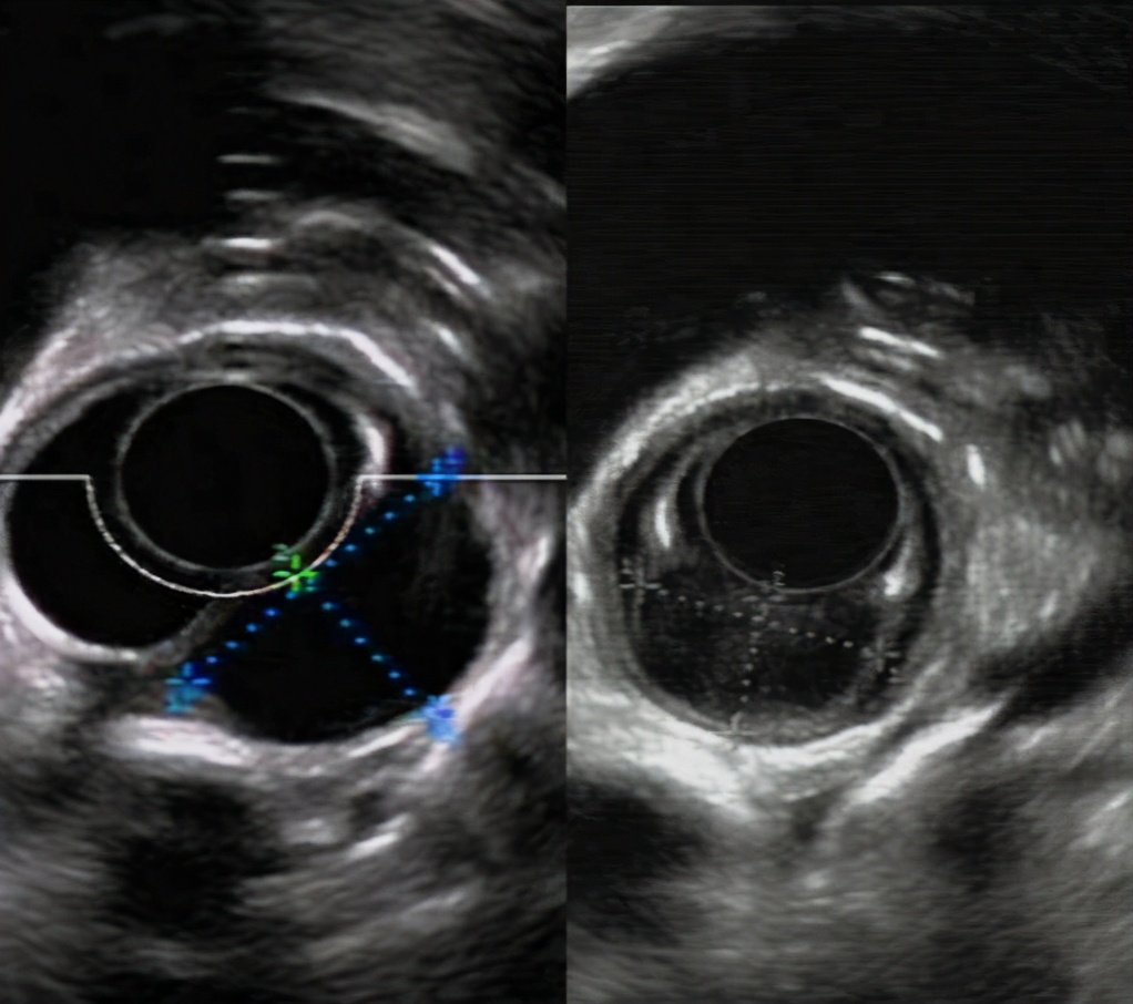 粘膜下开隧道精准切除两个肿物哈医大一院消化内科专家为食管多发粘膜下肿物微创治疗提供新思路