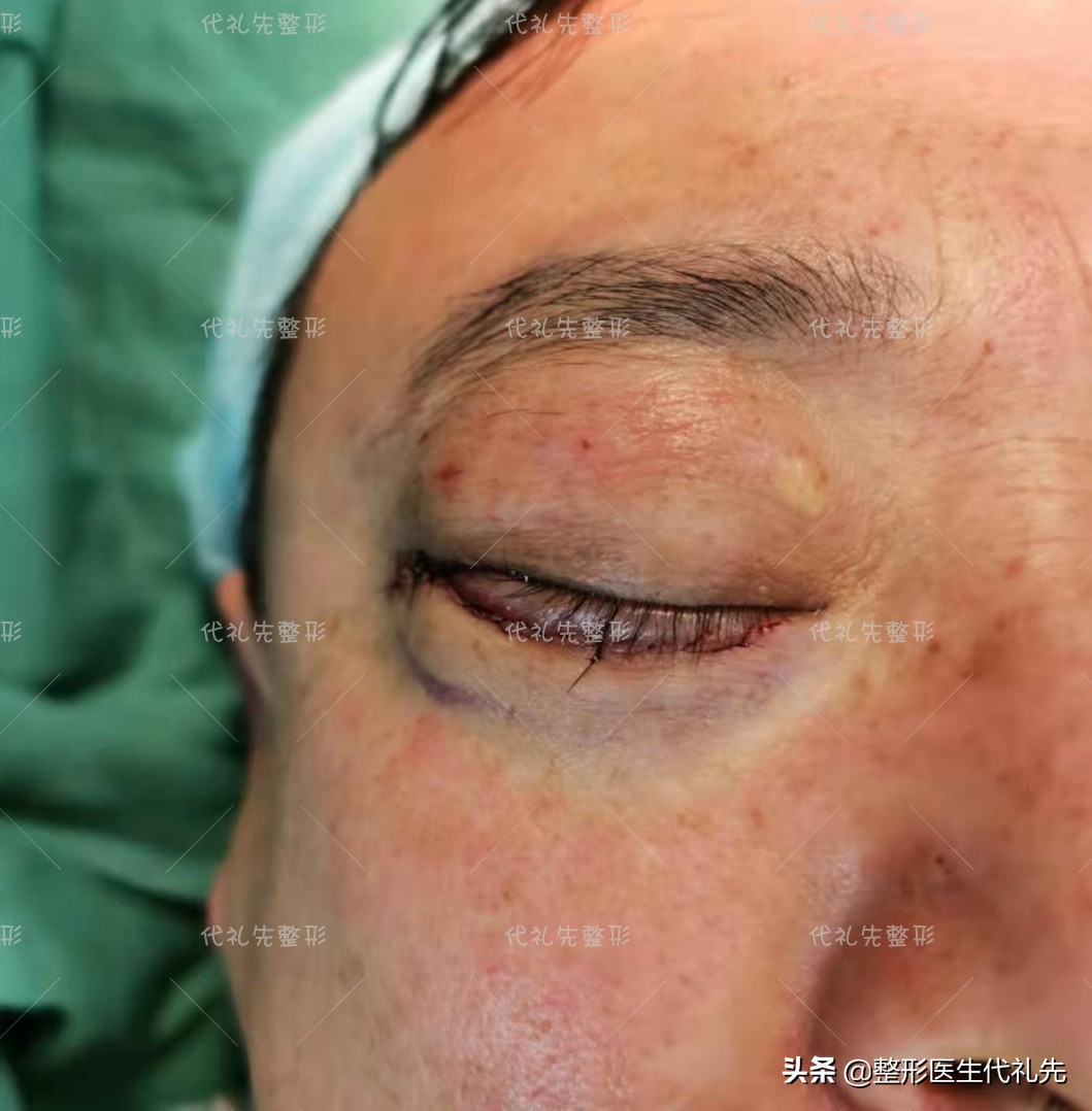 问一下有什么方法快速消除眼袋,关于眼袋的去除方法