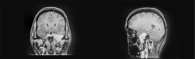 面麻是怎么引起的,面麻痛