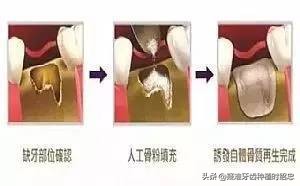 想种植牙牙槽骨骨量不足怎么办,骨量不足种植牙最新技术