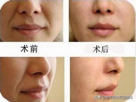 这3种方法解决法令纹效果很惊艳,这3个方法帮你去除法令纹