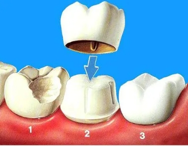 牙齿矫正和做牙冠哪个更好,牙齿矫正和烤瓷牙哪个更简单