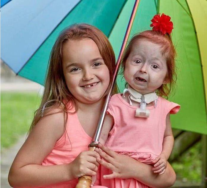 2岁女孩基因突变长得像80岁老人,2个孩子患罕见遗传病