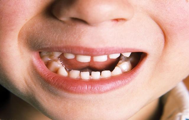 儿童牙缝大小多少合适,你们家的宝宝牙缝也是这么宽吗