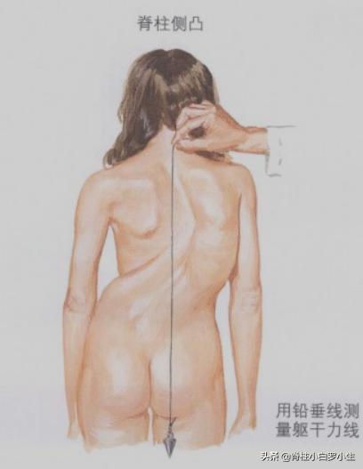 孩子脊柱侧弯怎么治疗,孩子脊柱侧弯最佳治疗方法