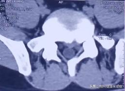 简单高效的治疗腰椎间盘突出,保守治疗腰椎间盘突出的方法
