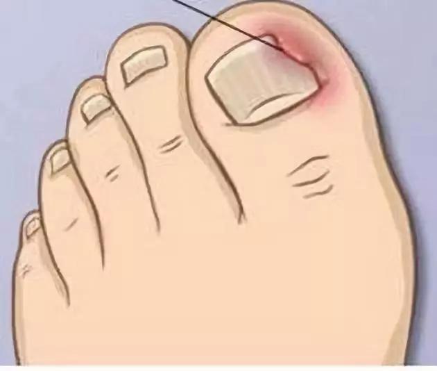 甲沟嵌甲从根部戳到肉里面怎么办,脚趾甲侧面嵌甲自己怎么处理