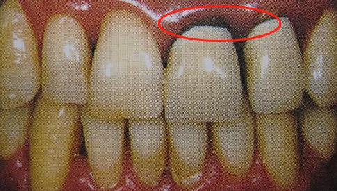 烤瓷牙修复缺陷图片,做了烤瓷牙后悔了有补救办法吗