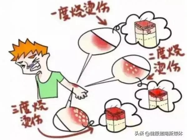 学点烧烫伤自救办法