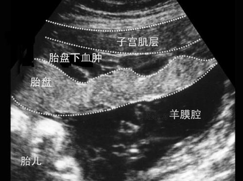 女儿不小心撞到孕妇,孕妇7个月被撞胎死腹中