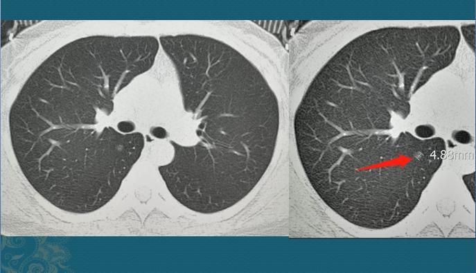肺磨玻璃结节，3年增大2mm，该不该手术？