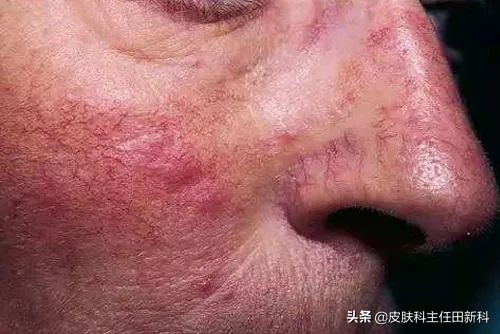 痘印变成斑点怎么治,痘印的种类以及成因你了解多少