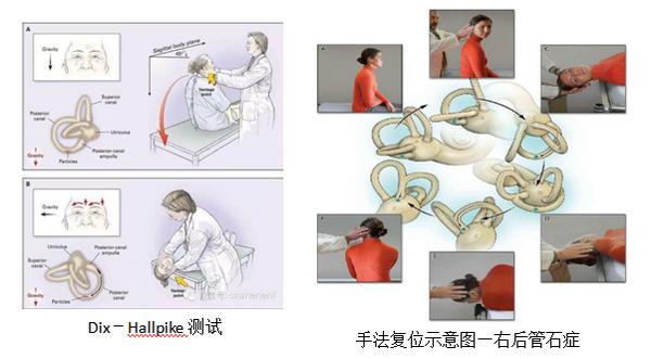 耳朵里面找金箍棒,耳朵里有定海神针怎么办