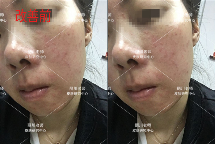 兰亭护肤品能治疗激素脸吗,兰亭护肤品有适合油皮长痘用的吗