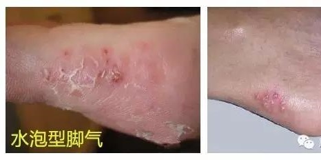 你有脚气吗健康养生,专家课堂讲治脚气