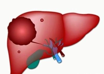 体检肝血管瘤怎么治,体检出肝血管瘤后需要怎么办