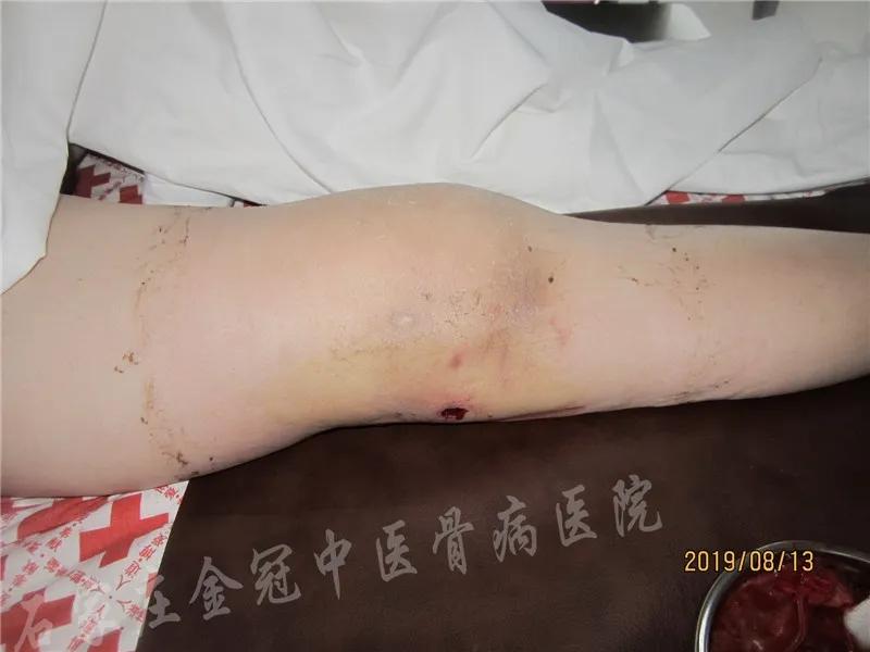 腰椎结核有哪些症状,腰椎结核手术2年开春腰疼