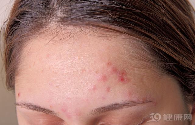 螨虫除不尽,螨虫怎么治疗可以除根不痒