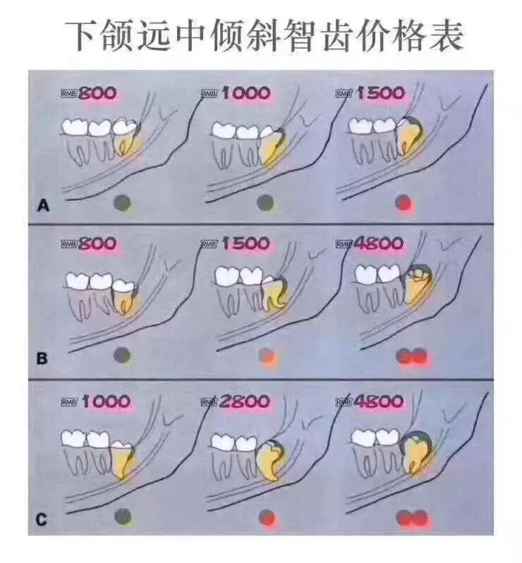 埋得越深,分手费越高——你所不知道的拔智齿收费依据