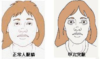 甲亢碘131治疗亲身经历,从甲亢到甲减的最典型症状表现