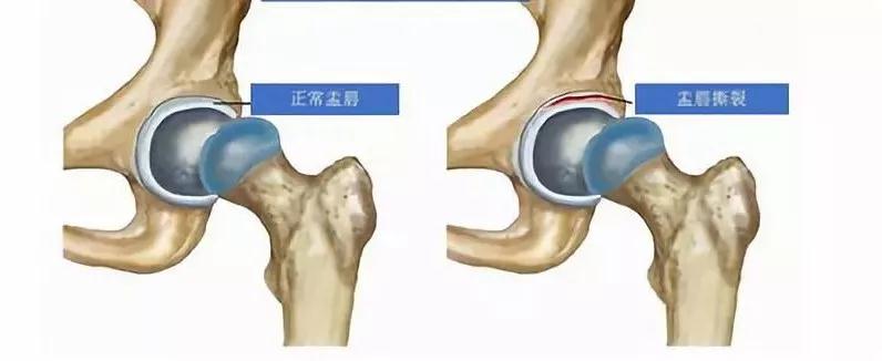 胯骨疼站立时间长了麻,胯骨痛走路都疼怎么回事