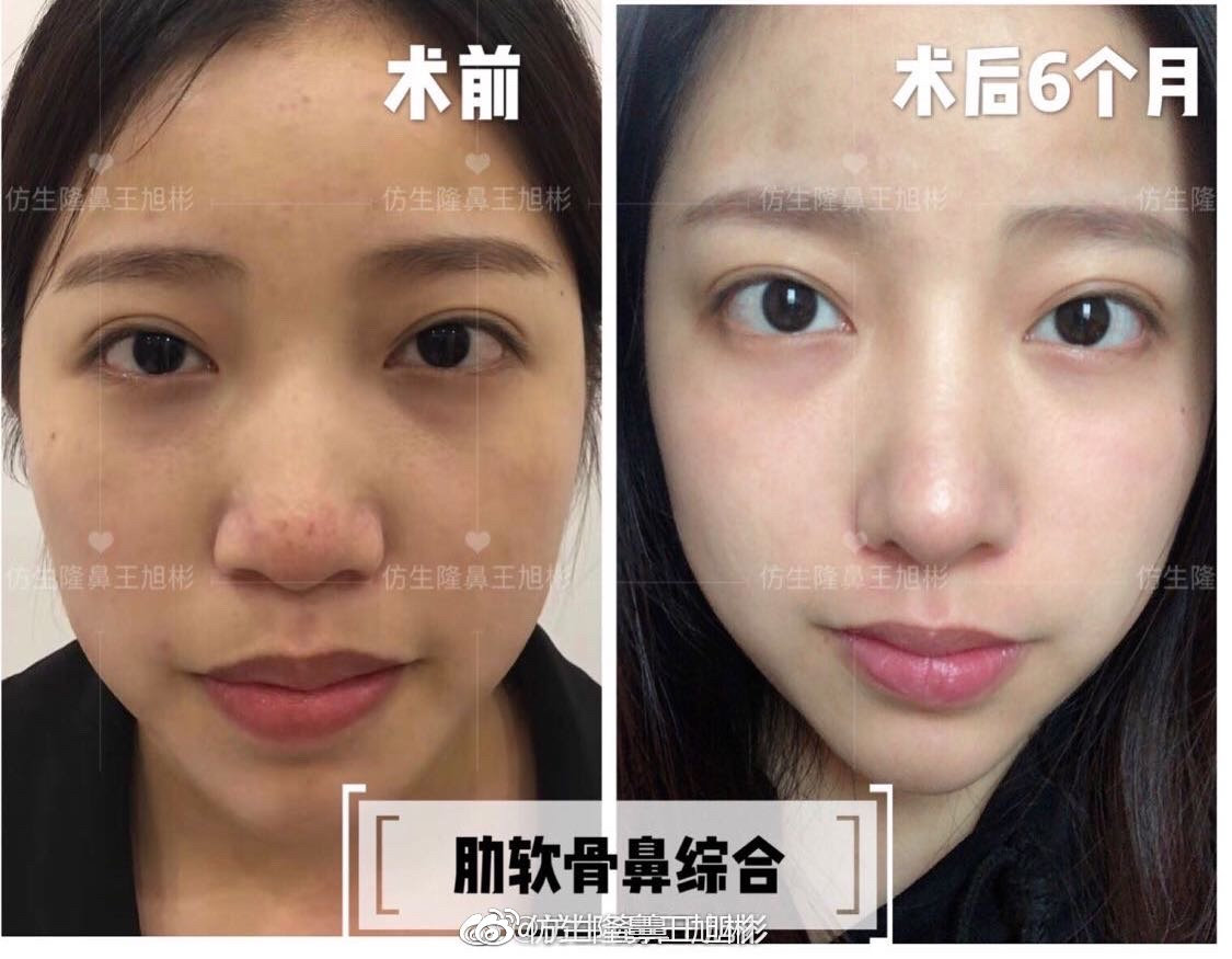 短鼻蒜头鼻整形,短鼻延长术切口