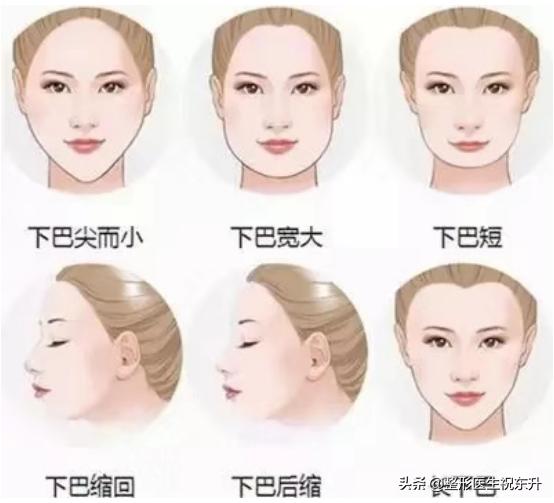 关于玻尿酸丰下巴的那些事...