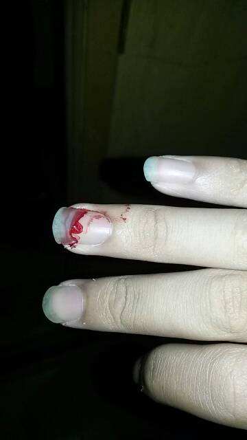 甲沟炎指甲盖劈了,为啥指甲盖劈着长