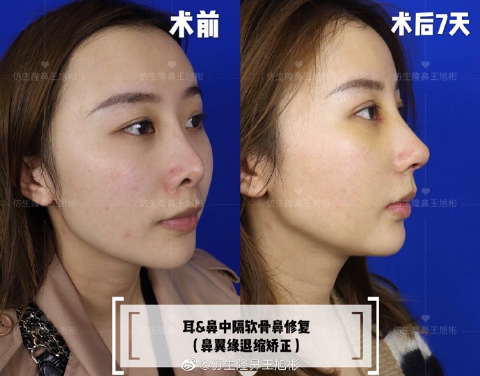 假体隆鼻耳软骨垫鼻尖图片,l型假体耳软骨隆鼻图片