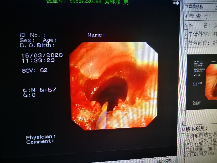 经支气管镜球囊扩张治疗气道狭窄,支气管镜球囊扩张操作视频