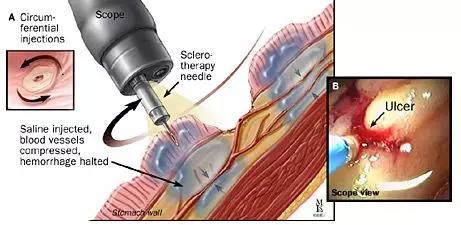 消化道出血的内镜治疗,消化道出血的内镜下治疗