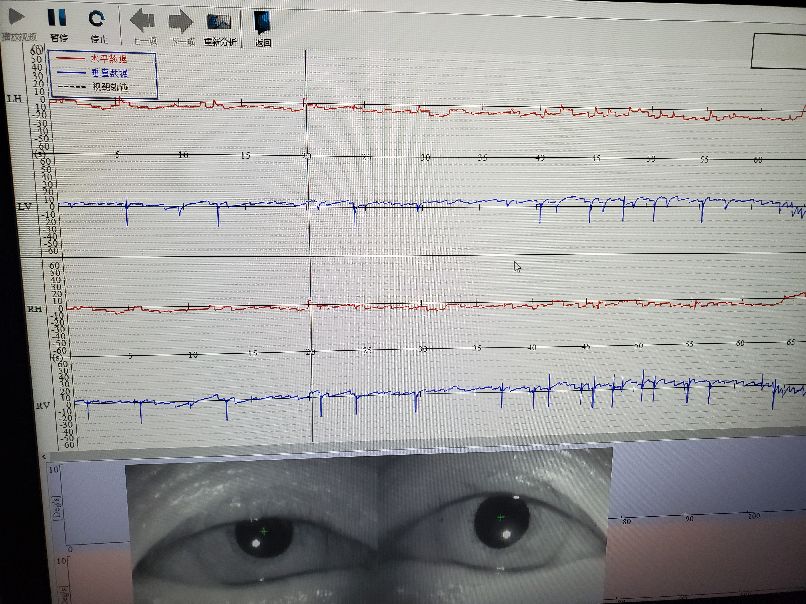 老年人颈椎病引起头晕恶心呕吐,头晕恶心干呕是不是颈椎病