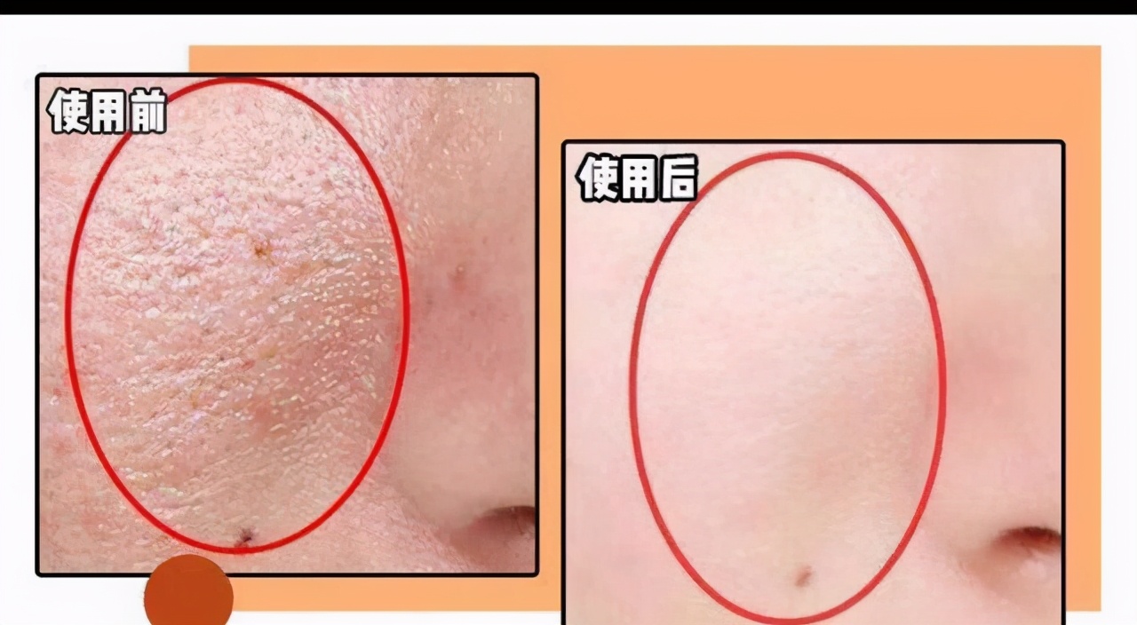 宝露斯毛孔收细套:赋活嫩滑肌肤、收缩毛孔渐平滑