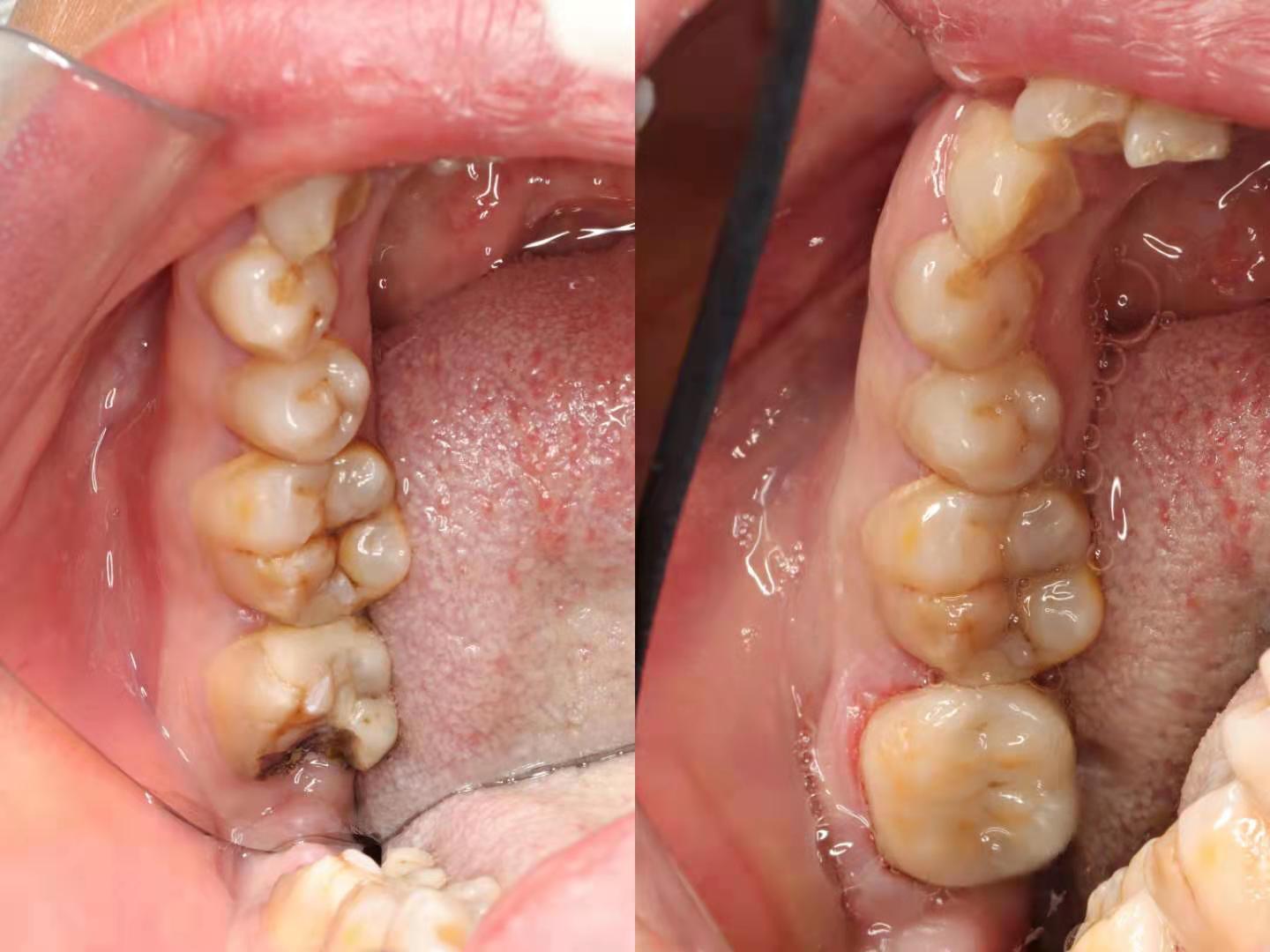 补牙补次数多了洞会越来越大吗,补牙补几次能补完