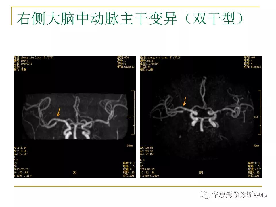 中国人脑立体定向mri应用解剖图谱,脑mri示意图