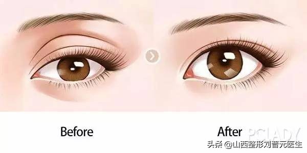 双眼皮的几种类型和区别,双眼皮几种类型