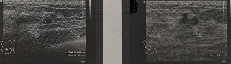 乳腺癌病例报告解读,肿瘤医生笔记乳腺癌篇转载