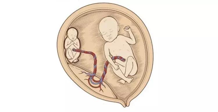 辟谣：“喜当爹”之后续，那个消失了的“双胞胎”到底是真是假