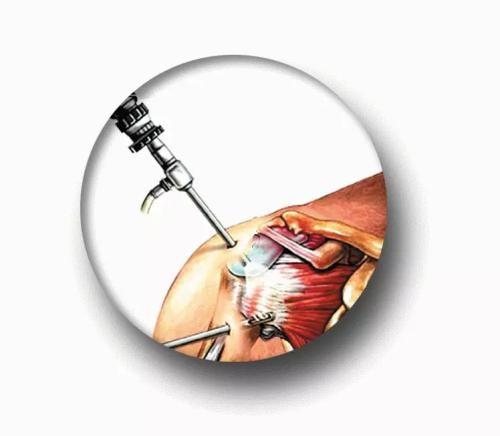 肩关节反复脱位影响干体力活吗,肩关节反复脱位核磁表现