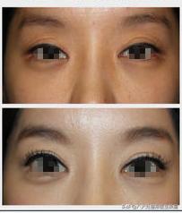 抬头纹真的与上睑下垂有关吗,睁大眼睛就有抬头纹怎么办