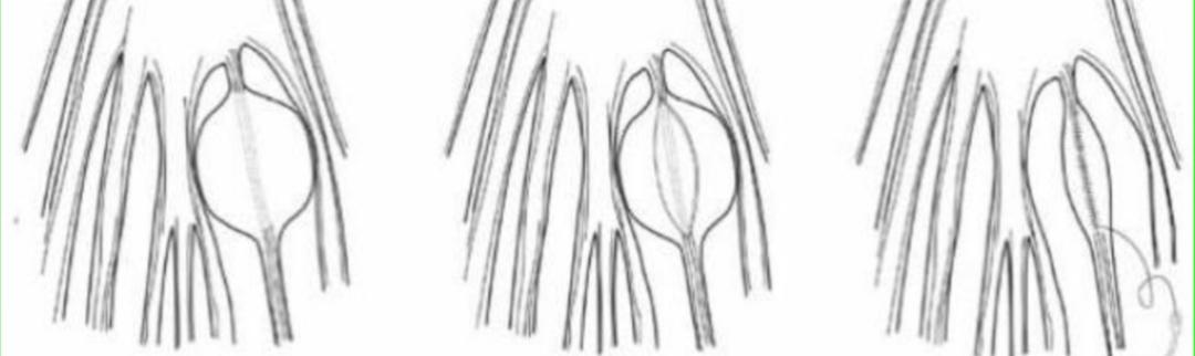 骶管蛛网膜囊肿怎么治疗,有症状的骶管囊肿检查得出来吗