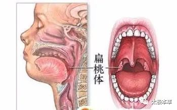 咽唾沫嗓子都疼,这里有办法治疗急性扁桃体炎