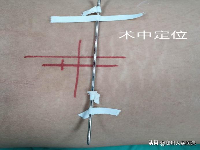 对骨科微创技术的认识,骨科手术与保守治疗对比