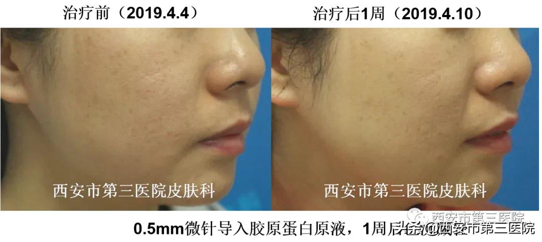 紧致肌肤的微针,淡化细纹微针