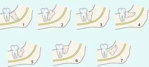 拔完智齿第5天了脸部发肿正常吗,拔完智齿一个月脸部还是有些肿