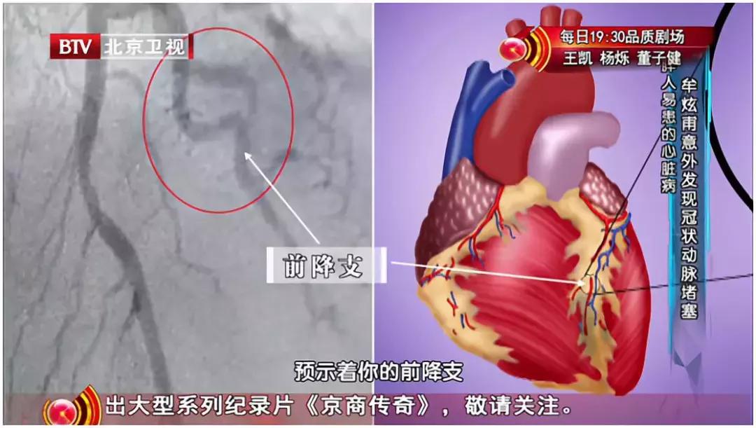 心梗很致命,非致命性心梗