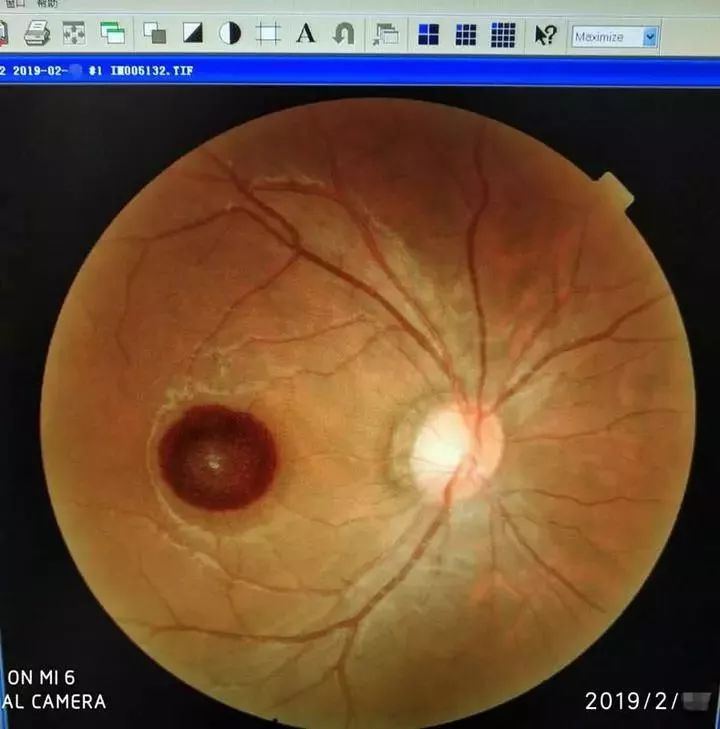 家中这些“杀手”一定要注意!2岁男孩腿上出现一凹陷的大洞