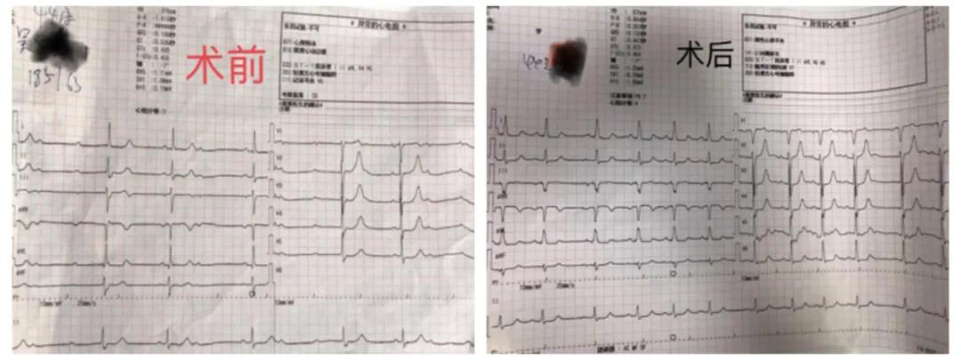 心脏起搏器植入,缓慢性心律失常起搏器植入术